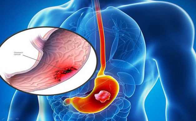 Viêm loét dạ dày cấp tính Chẩn đoá trúng để điều trị đúng  TCI Hospital