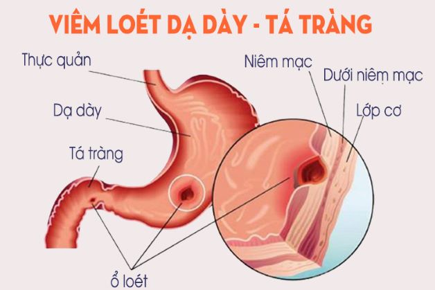 Viêm loét dạ dày cũng gây dạ dày đầy hơi