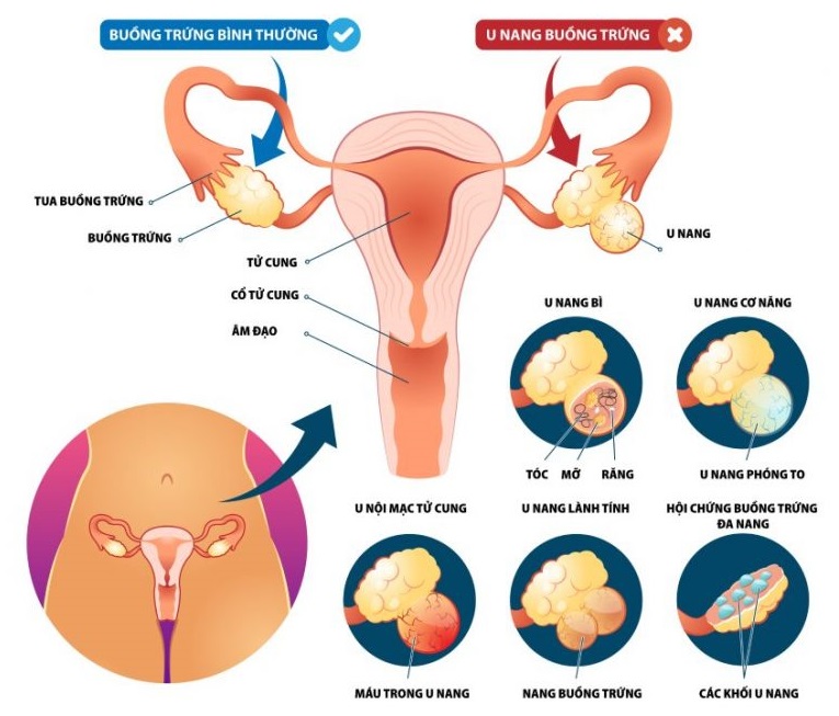 U nang buồng trứng là những khối u xuất hiện và phát triển bên trên hoặc bên trong buồng trứng của chị em