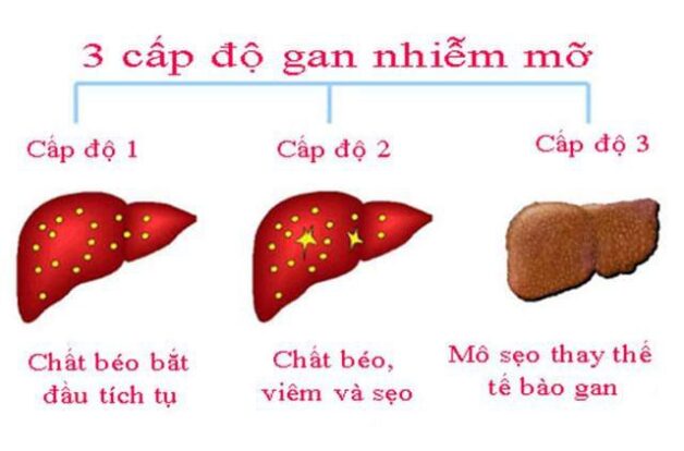 Trong 3 cấp độ của gan nhiễm mỡ, gan nhiễm mỡ độ 1 chưa gây ảnh hưởng tới người bệnh