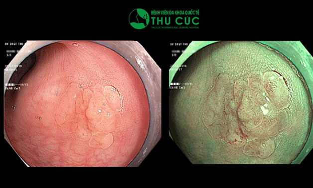 Nguy cơ ung thư cao từ Polyp đại tràng
