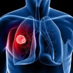 Ung thư phổi di căn vào xương – Biểu hiện và điều trị