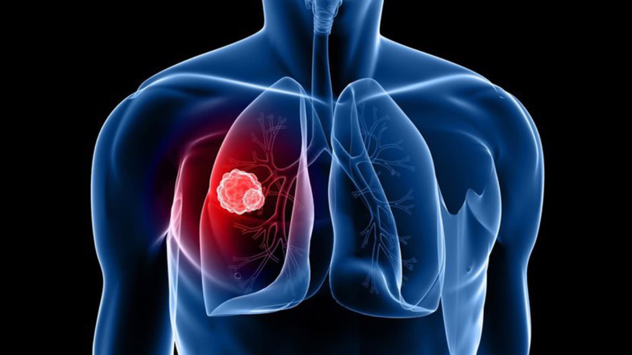 Phương pháp chẩn đoán ung thư phổi di căn xương hiệu quả nhất là gì?

