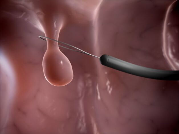 Cắt polyp đại tràng nội soi là cách chữa polyp đại tràng ít gây đau đớn nhất
