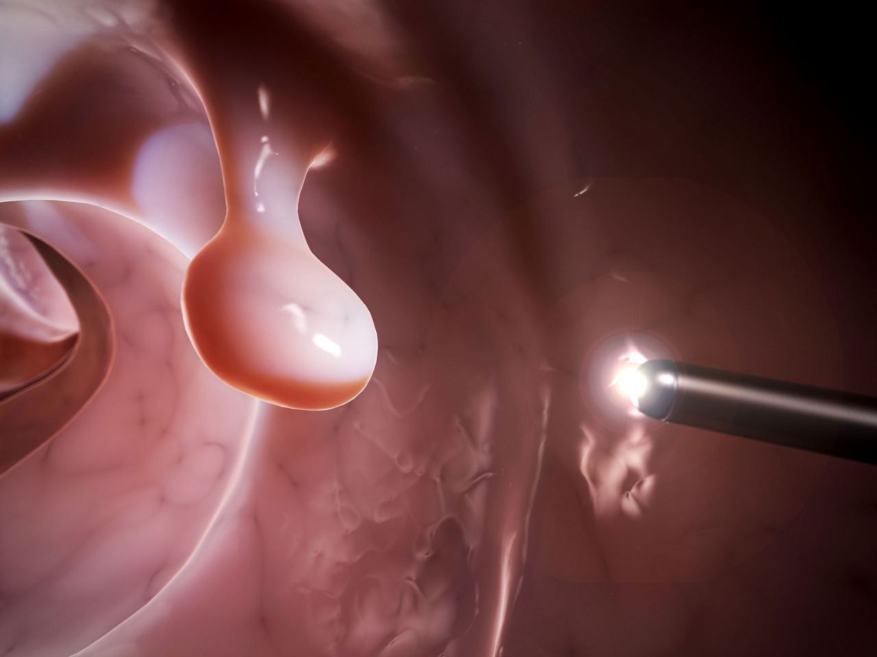 C c Lo i Polyp Trong i Tr ng V Gi i Ph p i u Tr c-c-lo-i-polyp-trong-i-tr-ng-v-gi-i-ph-p-i-u-tr