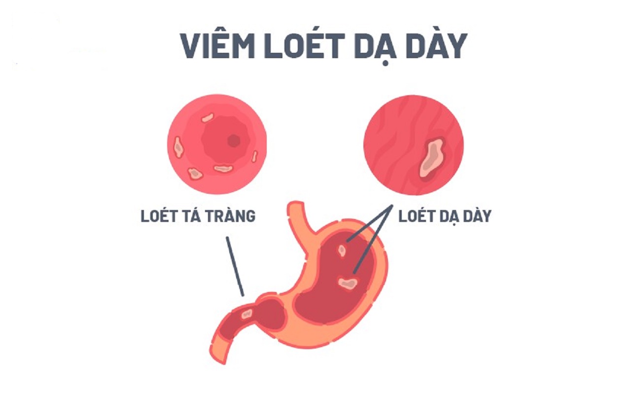 Cách điều trị và chăm sóc sinh lý dạ dày hiệu quả cho sức khỏe