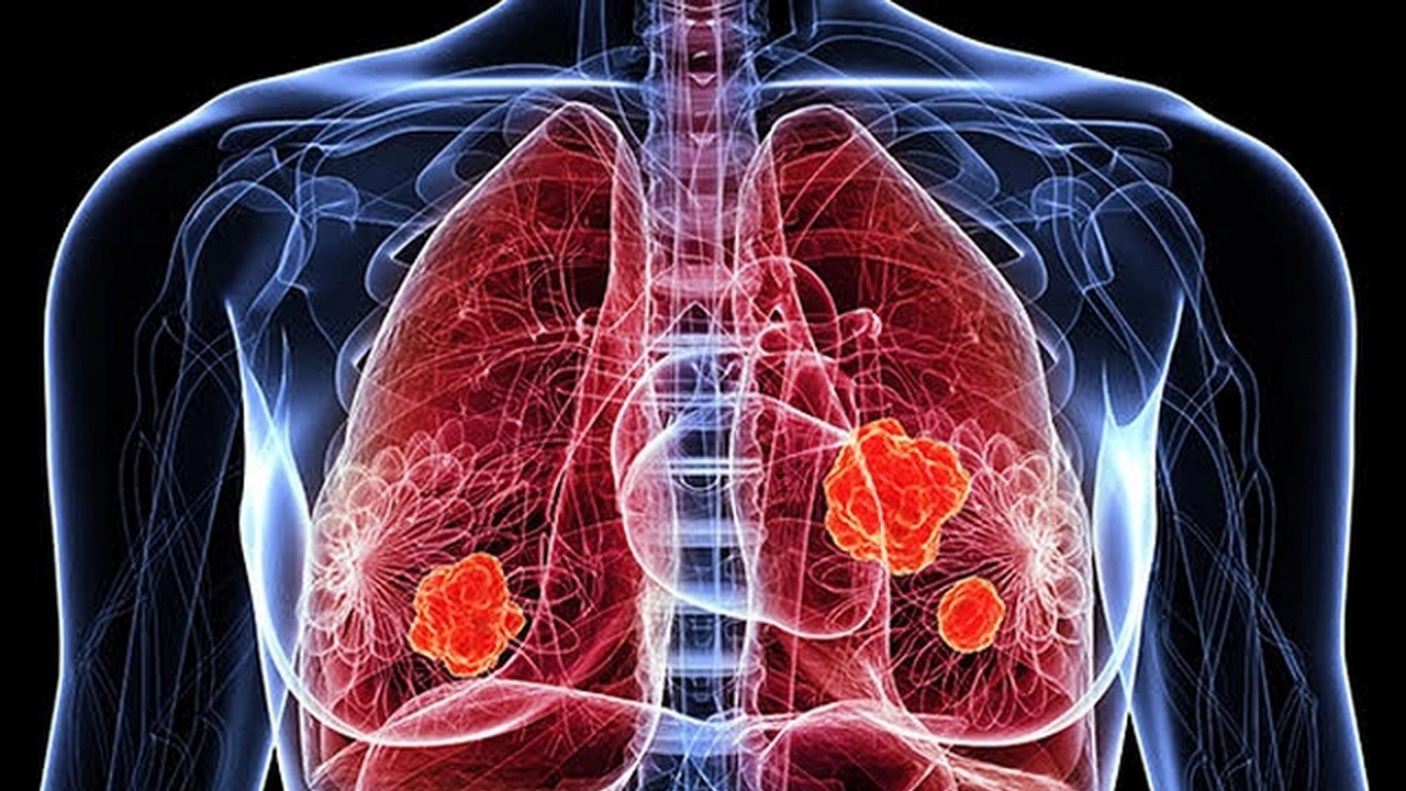 Làm thế nào để chẩn đoán ung thư phổi giai đoạn cuối?

