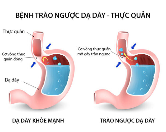 Đầy Bụng Trào Ngược Dạ Dày: Nguyên Nhân, Triệu Chứng và Giải Pháp Hiệu Quả