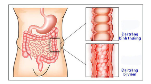 Đại tràng hàn và đại tràng nhiệt khi bị viêm
