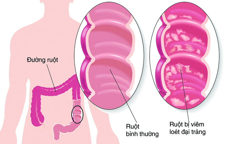 Viêm đại tràng màng giả có nguy hiểm không? | TCI Hospital