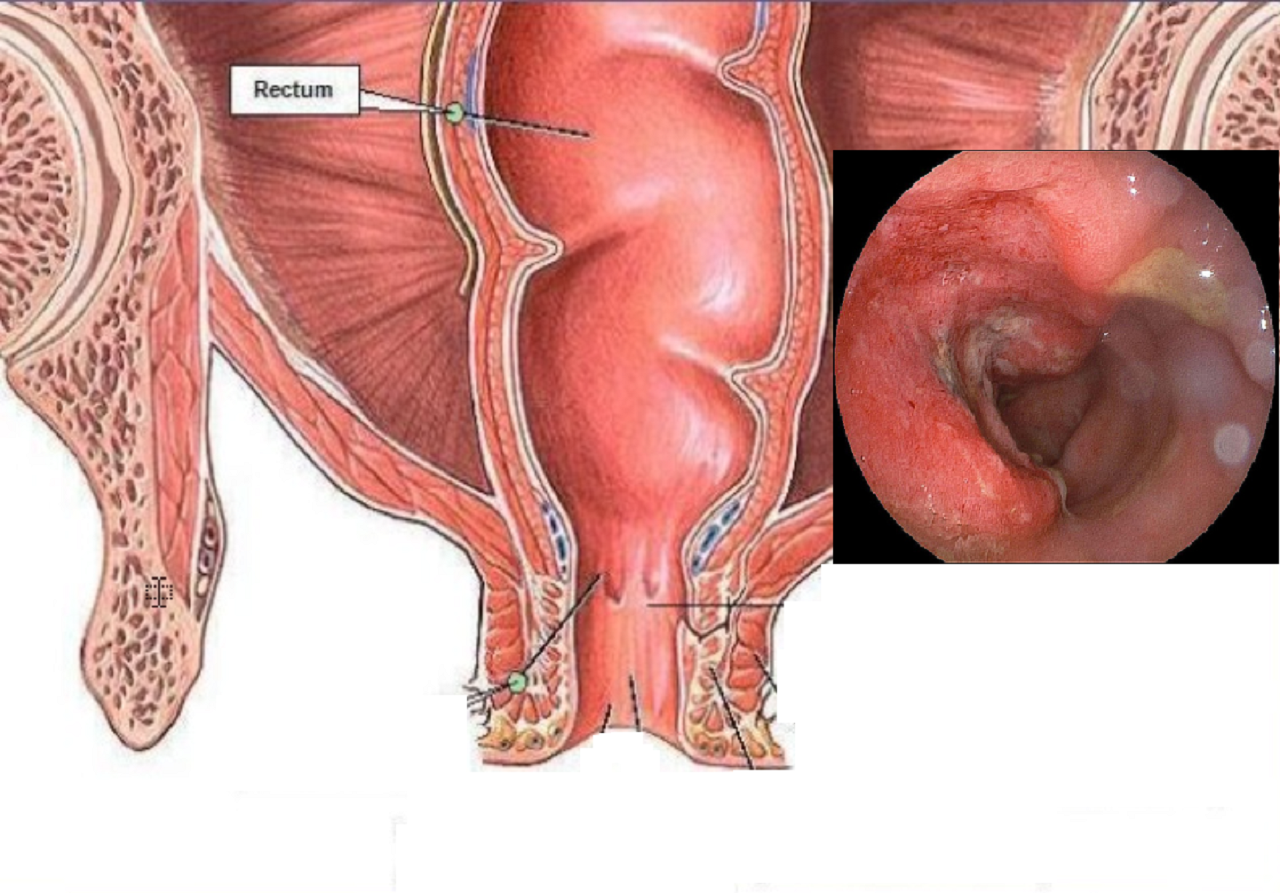 Viêm Đại Tràng Không Xác Định: Hiểu Biết và Giải Pháp Điều Trị Hiệu Quả