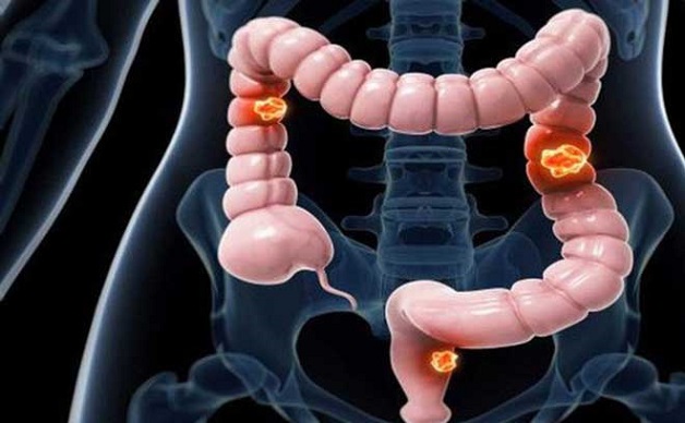 Viêm kết tràng là bệnh phổ biến ở hệ tiêu hóa