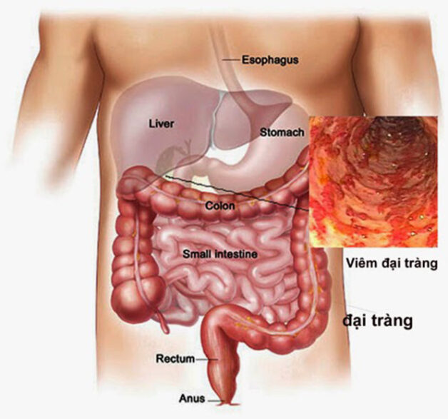 Đại Tràng Nhiều Hơi: Nguyên Nhân, Triệu Chứng và Giải Pháp Hiệu Quả