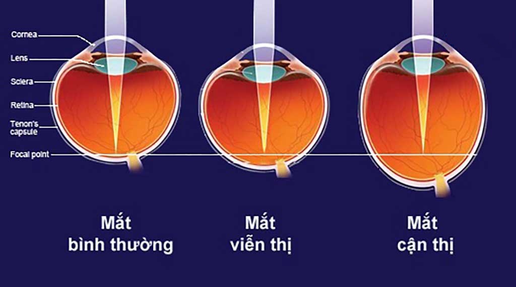  Nguyên nhân cận thị và viễn thị : Tìm hiểu về vấn đề mắt của bạn