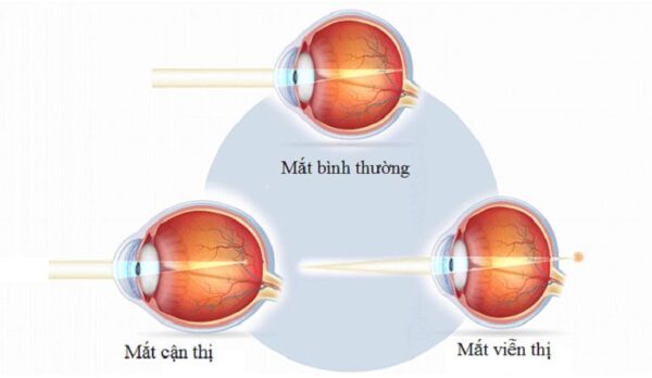 Thế Nào Là Cận Thị Viễn Thị? Khám Phá Nguyên Nhân và Giải Pháp