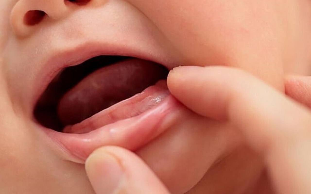 Tình trạng chậm mọc răng ở trẻ và cách khắc phục | TCI Hospital