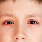 Giải đáp: Đau mắt đỏ ở trẻ em bao lâu thì khỏi?
