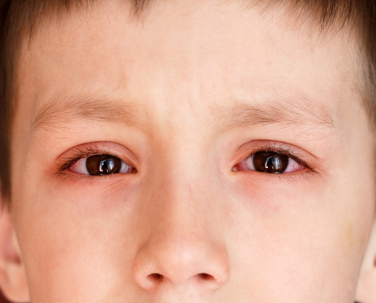 Triệu chứng đau mắt đỏ ở trẻ em như thế nào?
