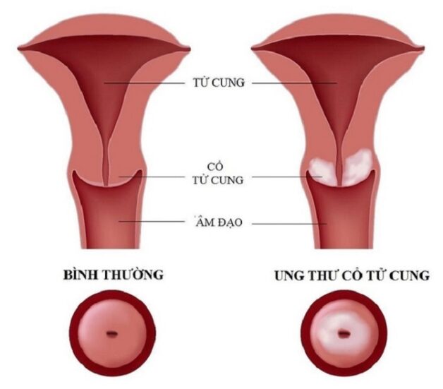 Kết quả soi cổ tử cung bất thường là như thế nào? | TCI Hospital