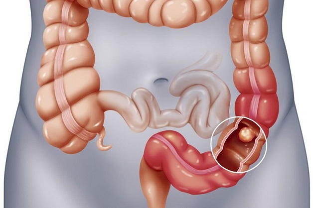 4. Phương Pháp Chẩn Đoán Polyp Đại Tràng