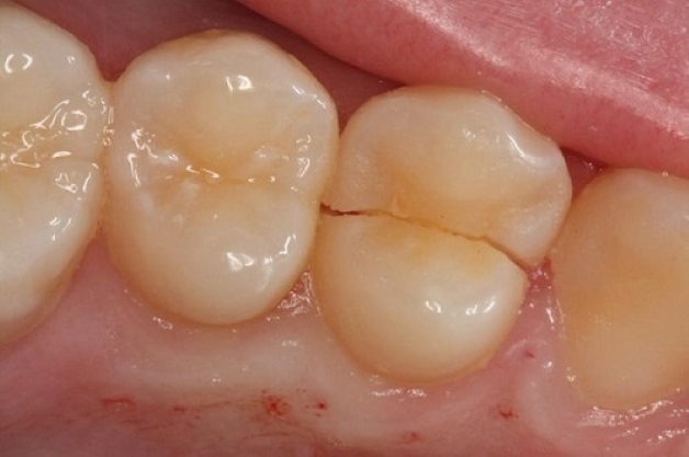 Răng lấy tủy bị vỡ