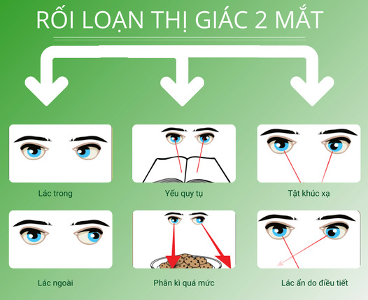 3. Dấu hiệu và triệu chứng rối loạn điều tiết mắt