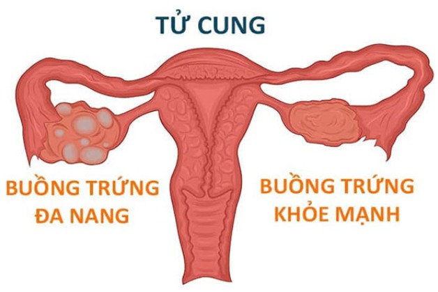 bệnh lý tại buồng trứng