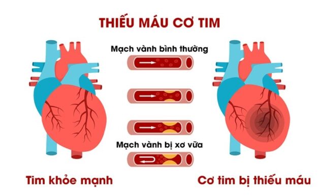 Thiếu máu cơ tim nên ăn gì và lưu ý chế độ ăn uống | TCI Hospital