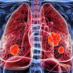 Tìm hiểu các chỉ số xét nghiệm máu tầm soát ung thư phổi