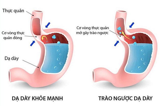 trao nguoc da day gay roi loan nhip tim 4