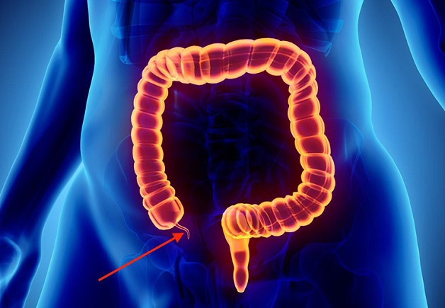 Viêm ruột thừa cấp là bệnh lý ở hệ tiêu hóa