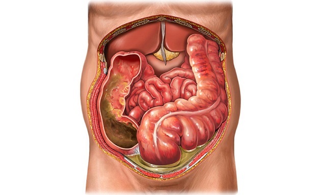 Đau ruột thừa cấp có thể gây viêm phúc mạc
