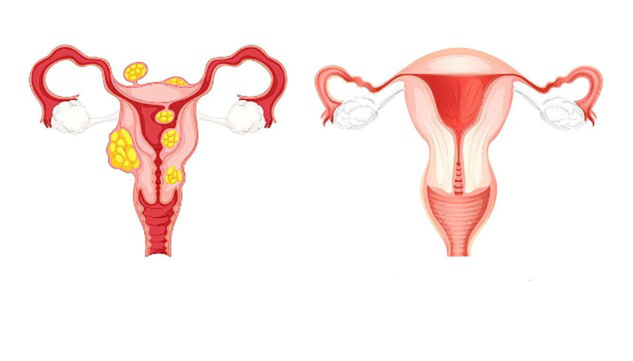 Cách phòng tránh tái phát nhân xơ tử cung sau khi đã điều trị là gì?