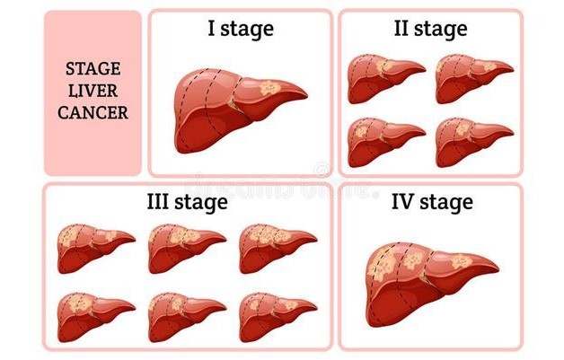 Các giai đoạn của ung thư gan biểu mô tế bào