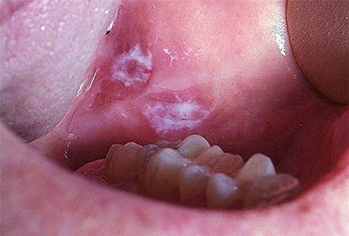 Tìm hiểu về dấu hiệu ung thư khoang miệng | TCI Hospital