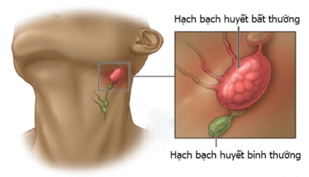 K tuyến giáp di căn hạch: Triệu chứng, Nguyên nhân và Cách Điều Trị Hiệu Quả