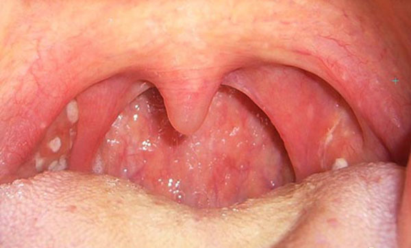 Hình ảnh ung thư vòm họng qua các giai đoạn  Vinmec