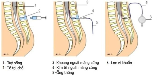 3. Chỉ định và chống chỉ định của gây tê ngoài màng cứng