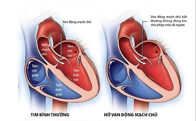 Bệnh lý thường xảy ra ở van động mạch chủ