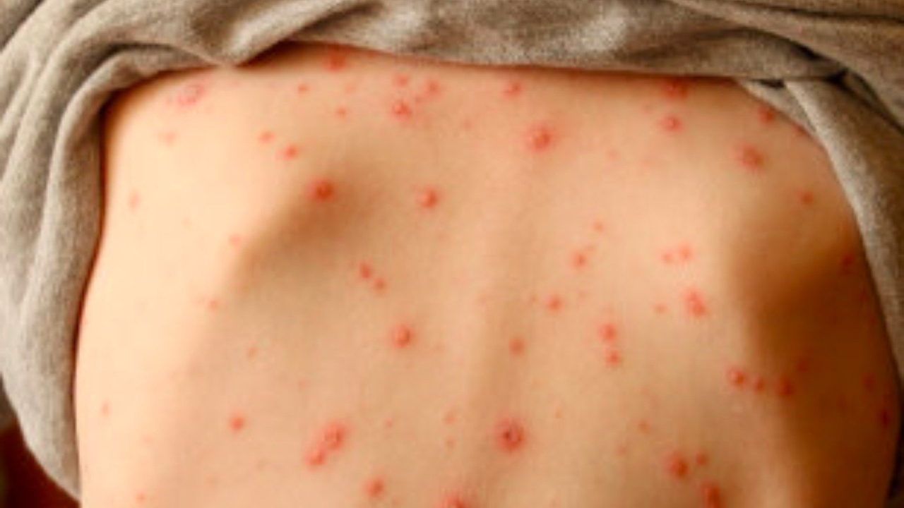 Virus Varicella-zoster có thể tồn tại và lây truyền qua các chất lỏng khác ngoài nước bọt không?
