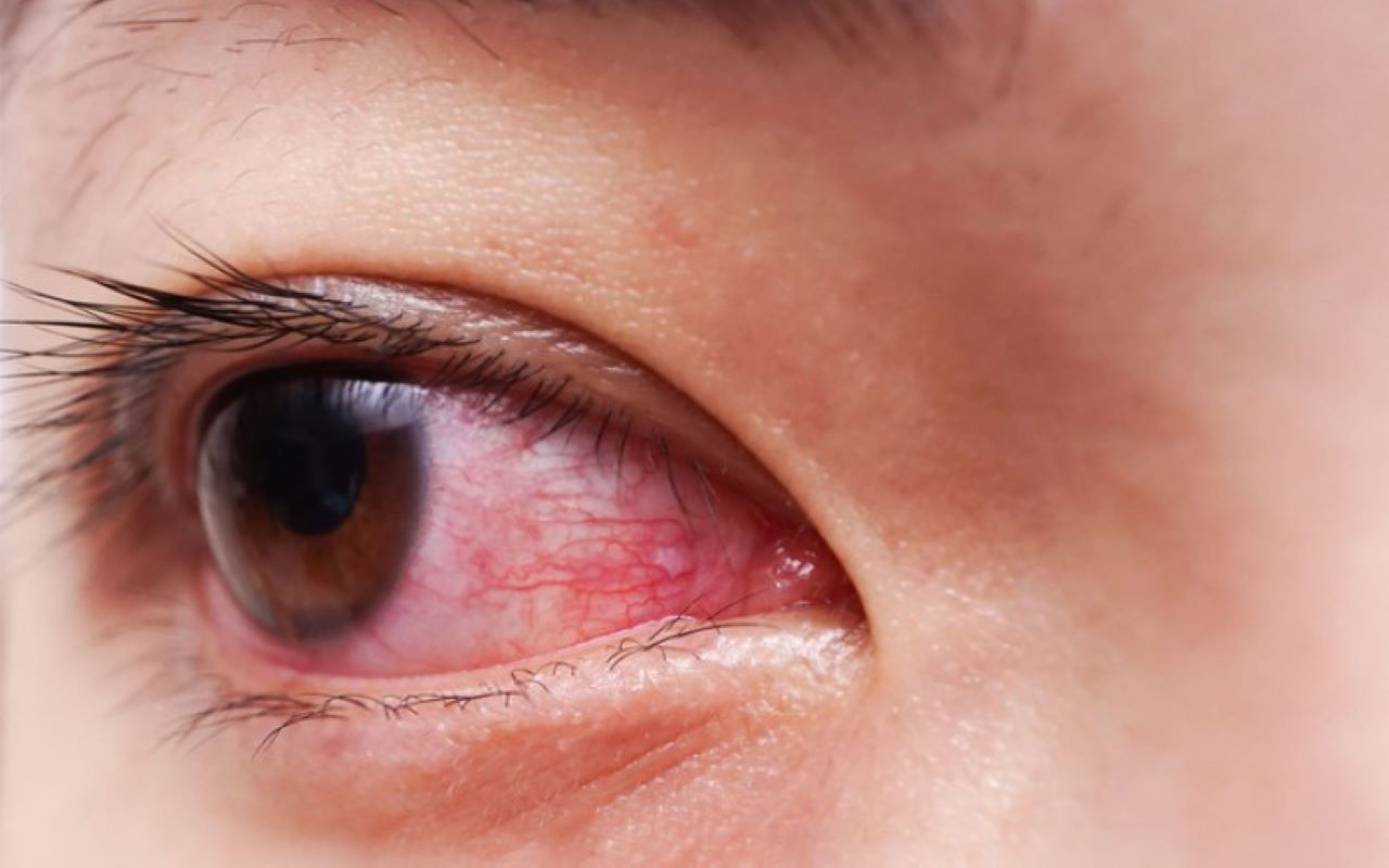 Chế độ ăn uống nào có thể giúp giảm triệu chứng đau mắt đỏ?
