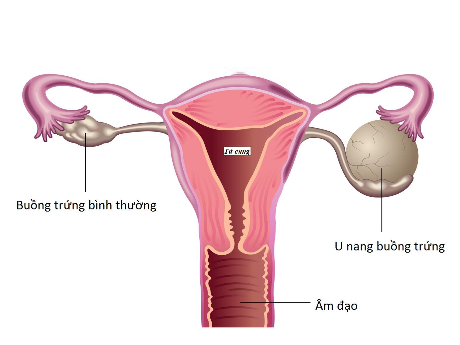 U nang buồng trứng là một tình trạng trong đó buồng trứng xuất hiện các khối u