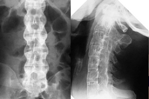 X-quang cột sống có thể cho thấy sự viêm, tổn thương và biến dạng của các khớp cột sống