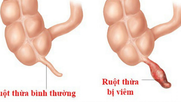 dau hieu benh ruot thua 1