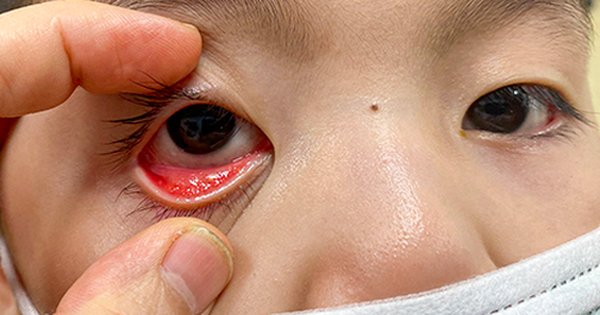 Đau mắt đỏ ở trẻ em: dấu hiệu và cách chữa | TCI Hospital