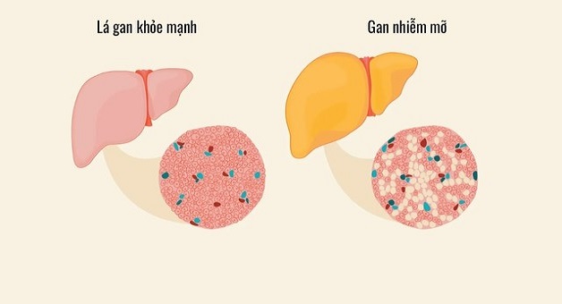 Gan bị nhiễm mỡ biểu hiện rõ