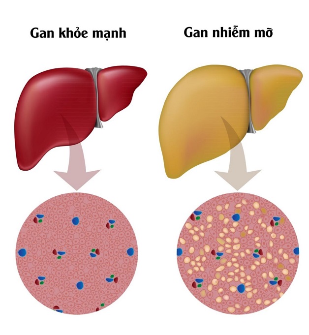 Bệnh gan nhiễm mỡ có nguy hiểm không và biểu hiện cụ thể