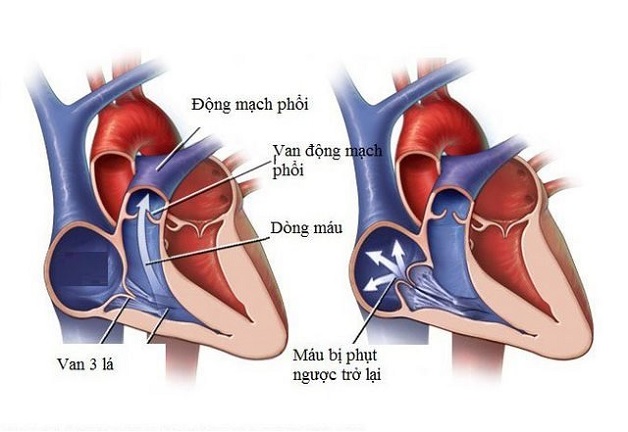 Hở van tim ba lá gây trào ngược máu vào tâm nhĩ phải