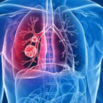 Khám tầm soát ung thư phổi ở đâu hiệu quả và chính xác?