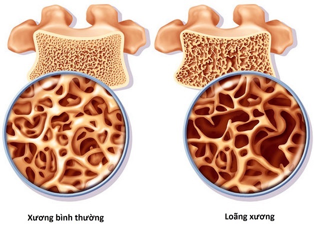 Loãng xương là tình trạng suy giảm chất lượng và khối lượng của xương